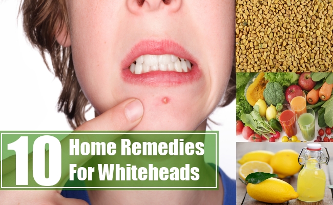 10 Home Remedies For Whiteheads Search Home Remedy 