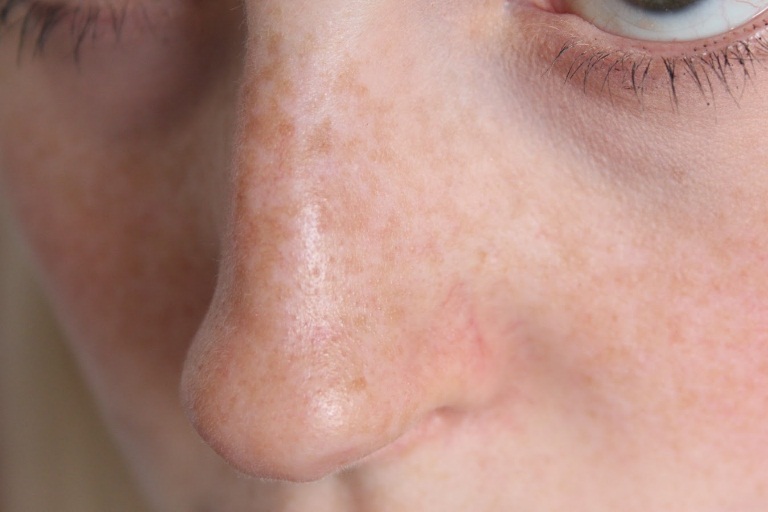 redness-around-nose-causes-treatment-home-remedies-and-more