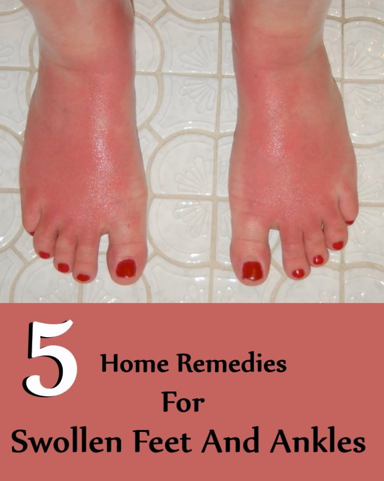 5 Home Remedies For Swollen Feet And Ankles | Search Home Remedy